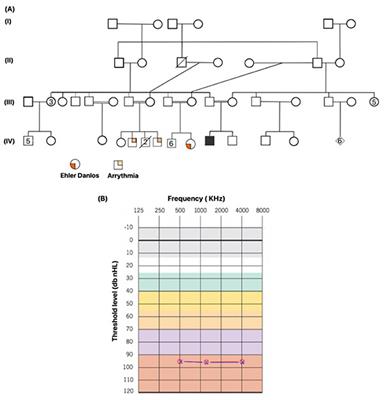 Case Report: Reinterpretation and Reclassification of ARSB:p.Arg159Cys Variant Identified in an Emirati Patient With Hearing Loss Caused by a Pathogenic Variant in the CDH23 Gene